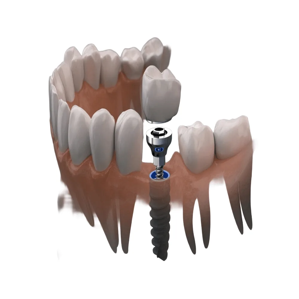 Implantes Dentales