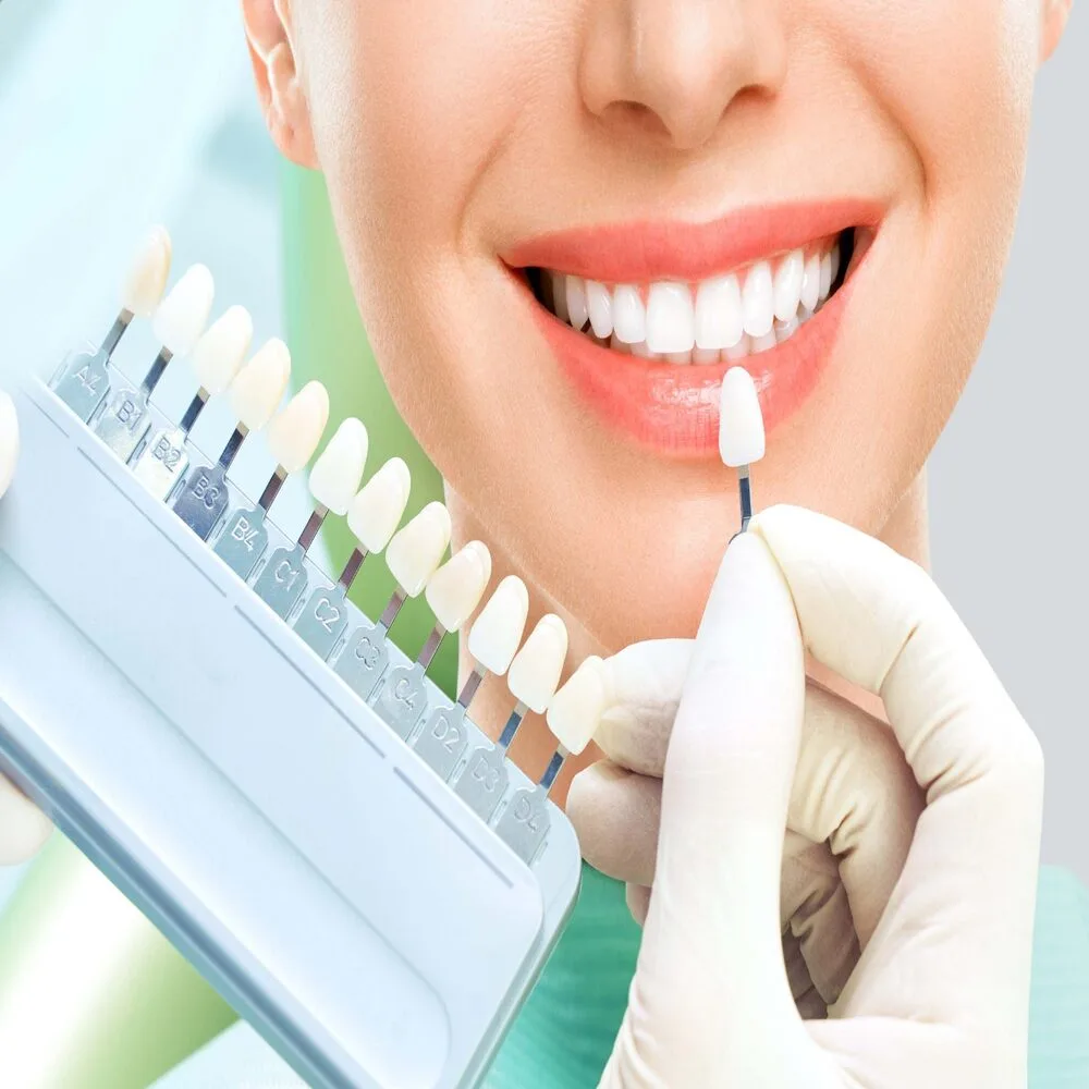 8 Carillas Dentales + 1 sesión de Blanqueamiento